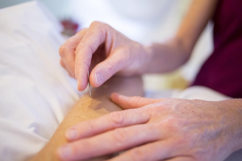 Acupuncture Image